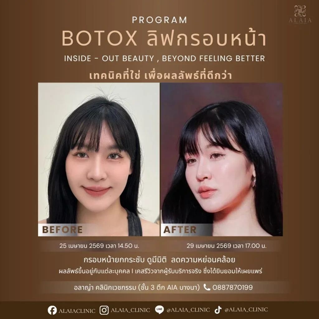 Program Botox ลิฟกรอบหน้า Review